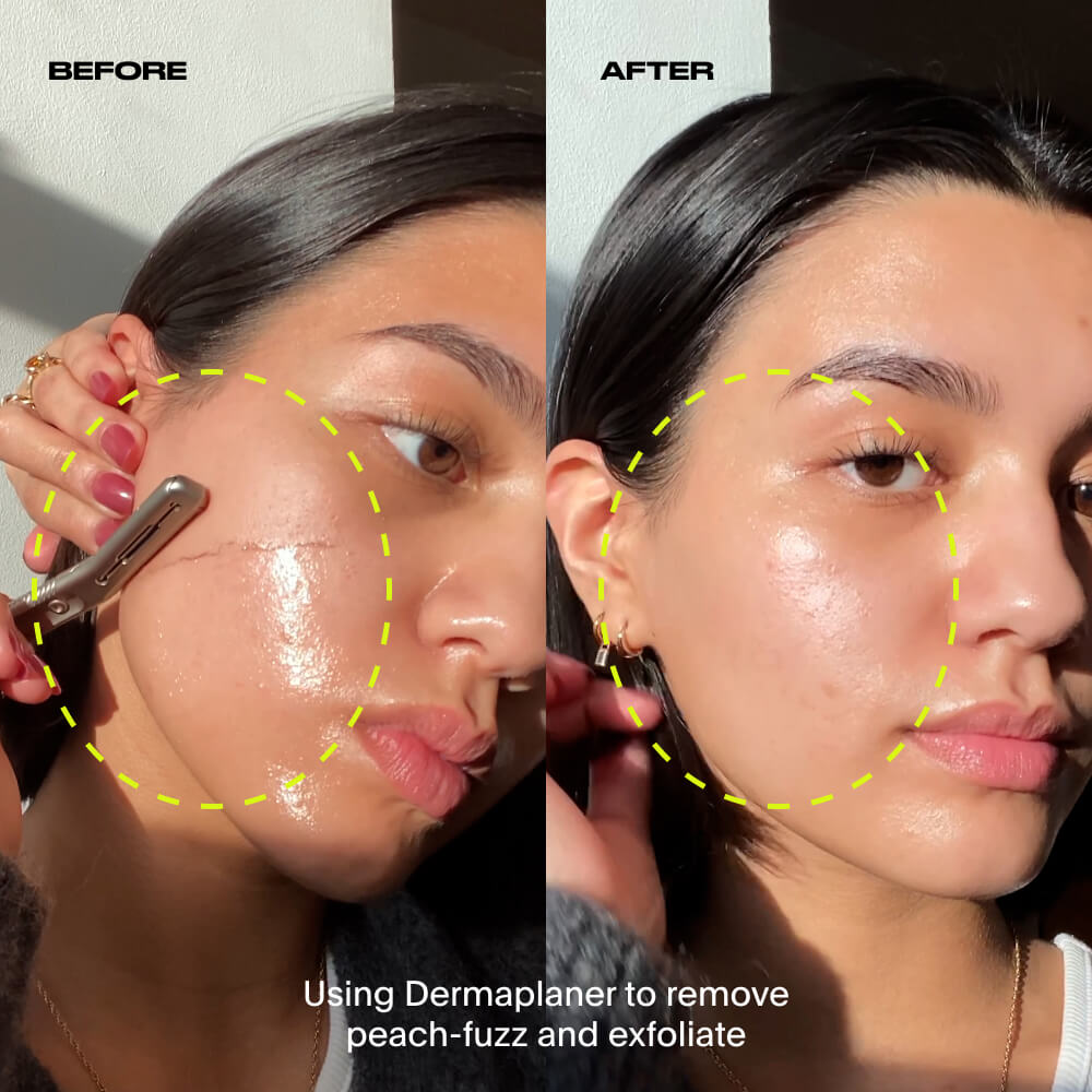 Dermaplaner